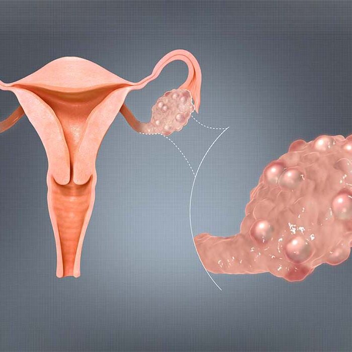 Polycystic-Ovaries-Syndrome